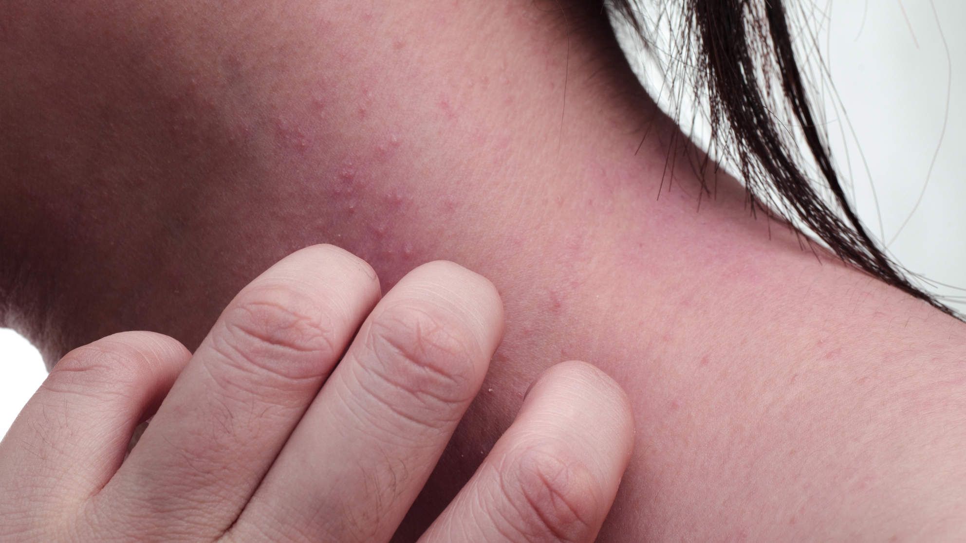 Eczema Causes: What to Do If You Have Dry, Itchy Skin